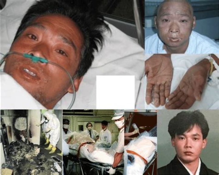 Tragic Tale Of Hisashi Ouchi: Radiation Poisoning's Gruesome Toll