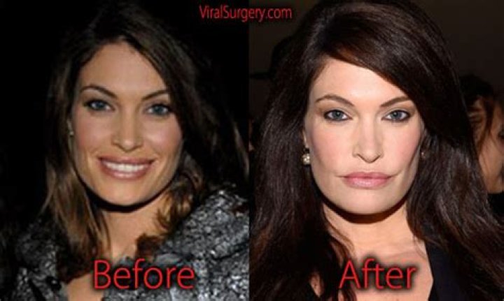 Unveiling The Transformation: How Much Plastic Surgery Has Kimberly Guilfoyle Had?