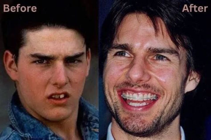The Shocking Truth: Tom Cruise's Dental Disasters